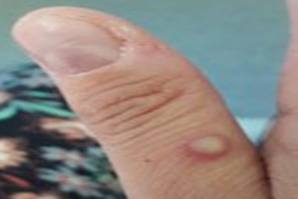 Global Health Emergency in Pakistan; two new Mpox cases detected