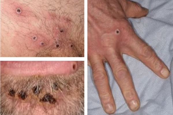 Health Ministry Reports Suspected Mpox Case; Patient Stable and Isolated