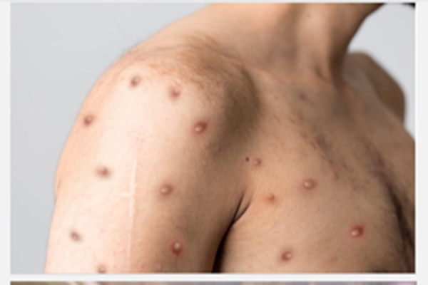 First Case of Clade 1B M-Pox Variant Detected in Kerala