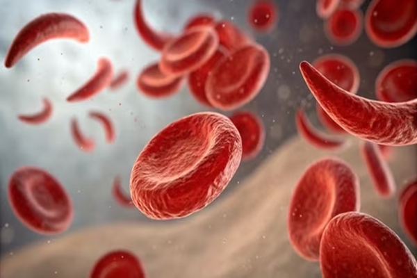Six crore screened under Sickle Cell Mission; over 2 lakh diagnosed, 16 lakh carriers identified