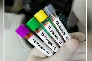 India Records 21% Decline in Tuberculosis Cases Over Last Decade: WHO Report