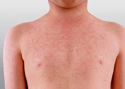 New South Wales Issues Measles Alert for Western Sydney Amid Rising Cases