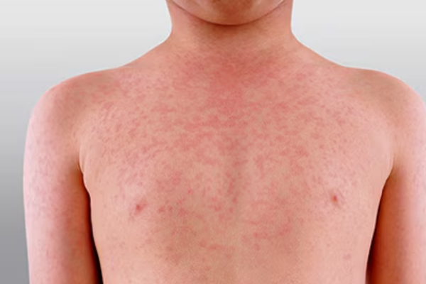 New South Wales Issues Measles Alert for Western Sydney Amid Rising Cases