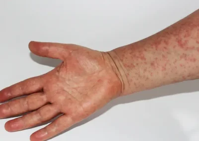 World Health Organization Flags High Measles Outbreak Risk in Bangladesh